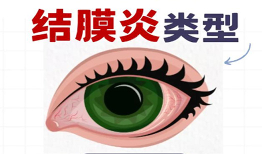 结膜炎是一种常见的眼部疾病。
